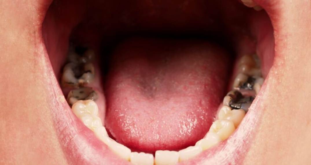 badteeth